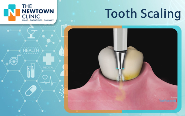 Tooth Scaling