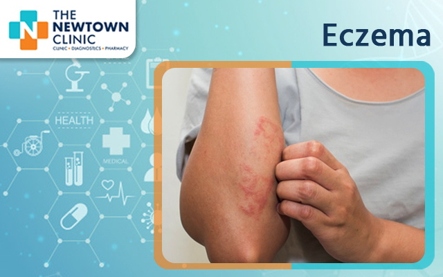 Eczema – Symptoms and Risk Factors – The Newtown Clinic