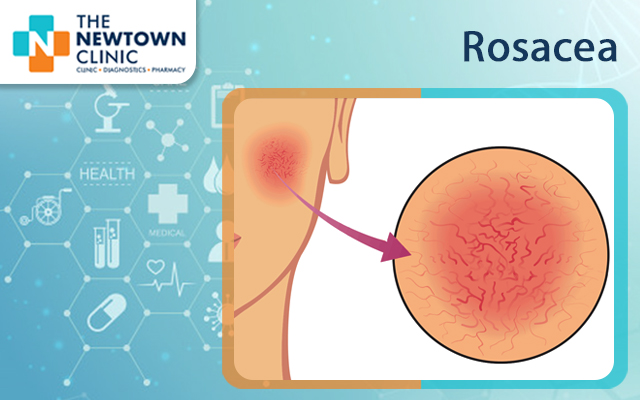 Rosacea