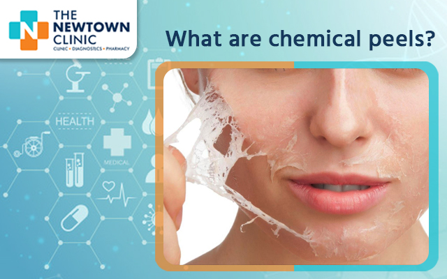 What Are Chemical Peels