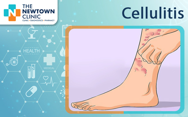 Cellulitis