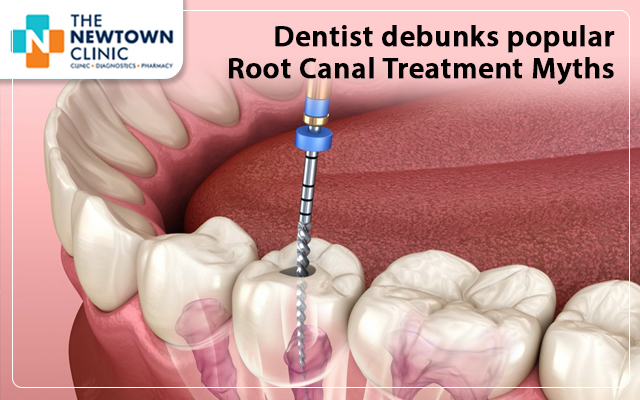 Dentist debunks popular Root Canal Treatment Myths