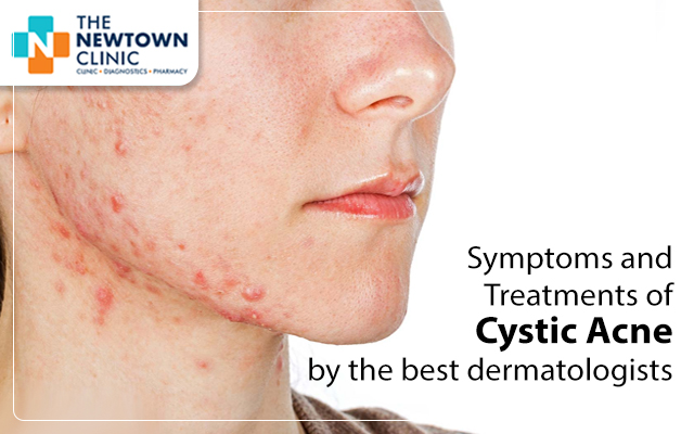 Symptoms and Treatments of Cystic Acne by the best dermatologists