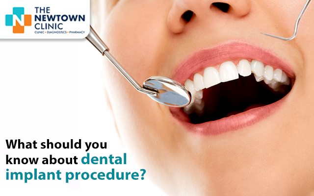 What should you know about dental implant procedure?