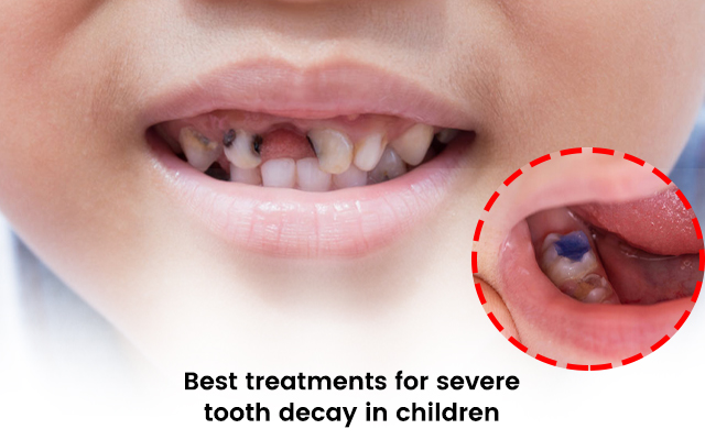 Best Treatments for Severe Tooth Decay in Children by The Newtown Clinic