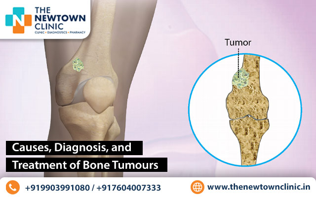 Causes, Diagnosis, and Treatment of Bone Tumours