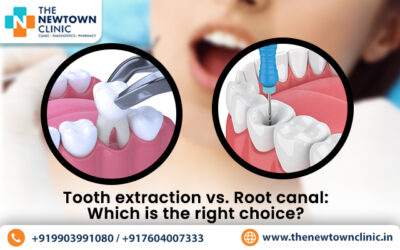 Tooth Extraction vs. Root Canal: Which is the Right Choice?