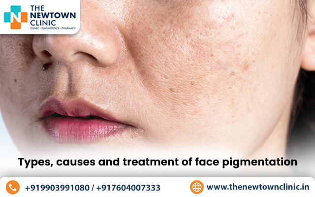 Types, causes and treatment of face pigmentation