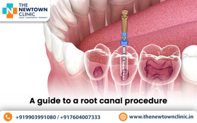 A guide to a root canal procedure