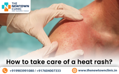 How to take care of a heat rash?