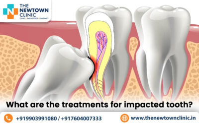 What are the treatments for impacted teeth?