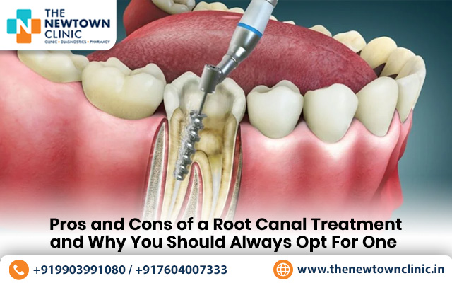 root canal treatment good or bad