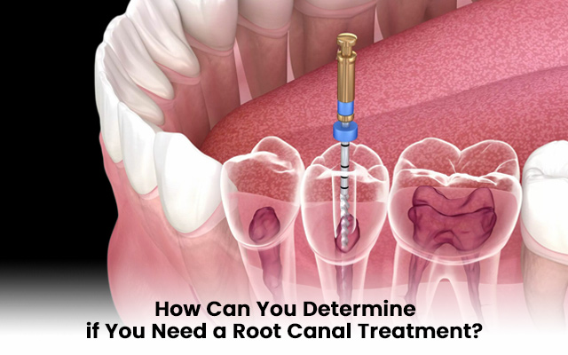 root canal treatment steps