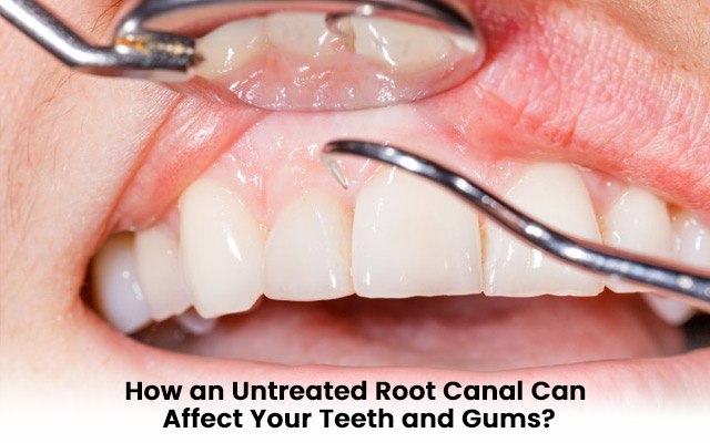 root canal treatment after effects