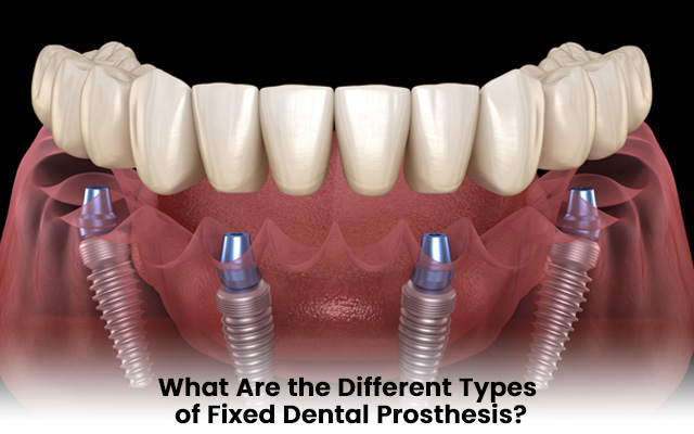 What Are the Different Types of Fixed Dental Prosthesis?