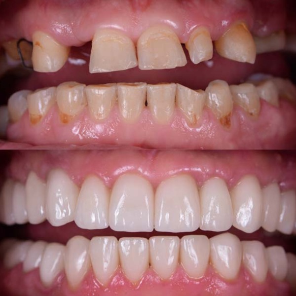 Cosmetic Dentistry Before and After