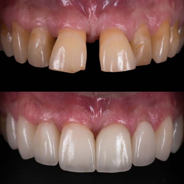 Cosmetic Dentistry Before and After