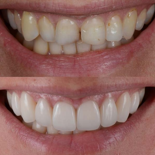 Cosmetic Dentistry Before and After