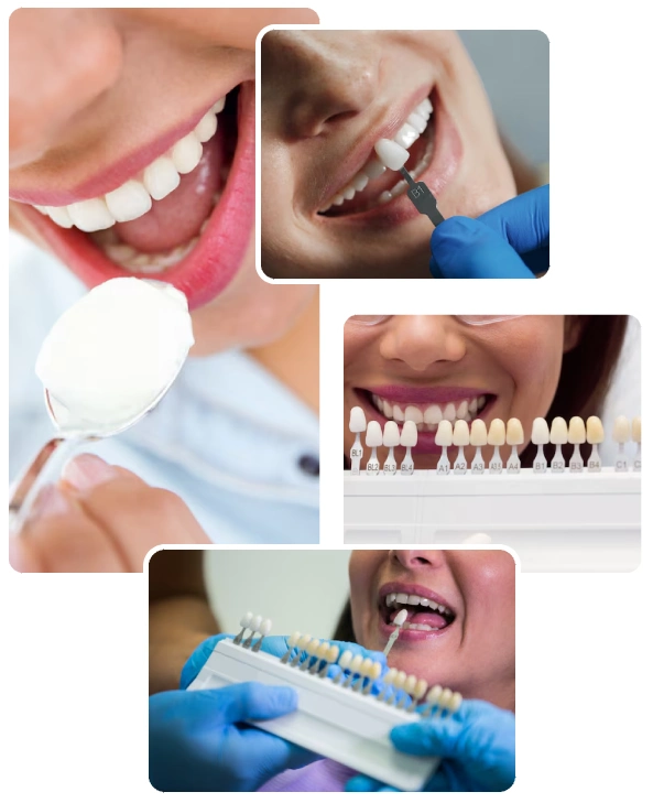 Teeth Whitening Procedure