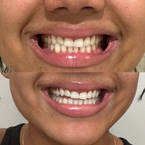 Teeth Whitening Before and After