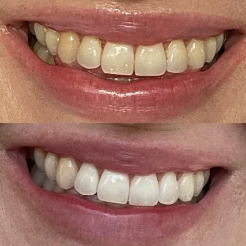 Teeth Whitening Before and After